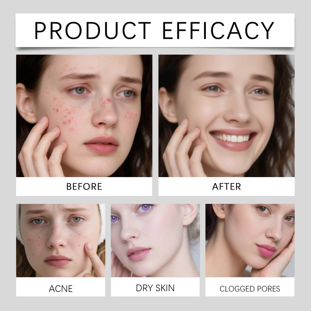 Hydrocolloid Pimple Patches – Clear Skin Support